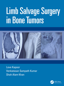 Limb Salvage Surgery in Bone Tumors