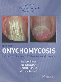 Onychomycosis: The Current Approach to Diagnosis and Therapy