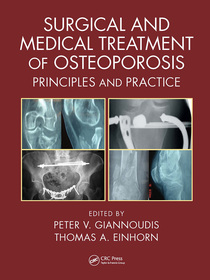 Surgical and Medical Treatment of Osteoporosis: Principles and Practice Surgical and Medical Treatment of Osteoporosis: Principles and Practice
