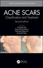Acne Scars: Classification and Treatment, Second Edition