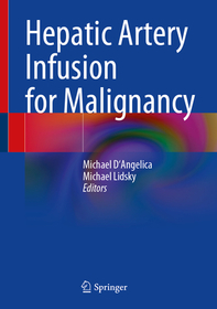 Hepatic Arterial Infusion for Malignancy