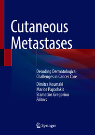 Cutaneous Metastases: Decoding Dermatological Challenges in Cancer Care