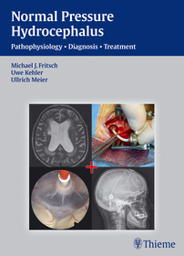NPH - Normal Pressure Hydrocephalus: Pathophysiology - Diagnosis - Treatment NPH - Normal Pressure Hydrocephalus: Pathophysiology - Diagnosis - Treatment
